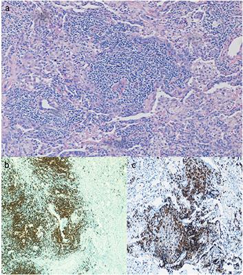 Interstitial Lung Disease in Common Variable Immunodeficiency